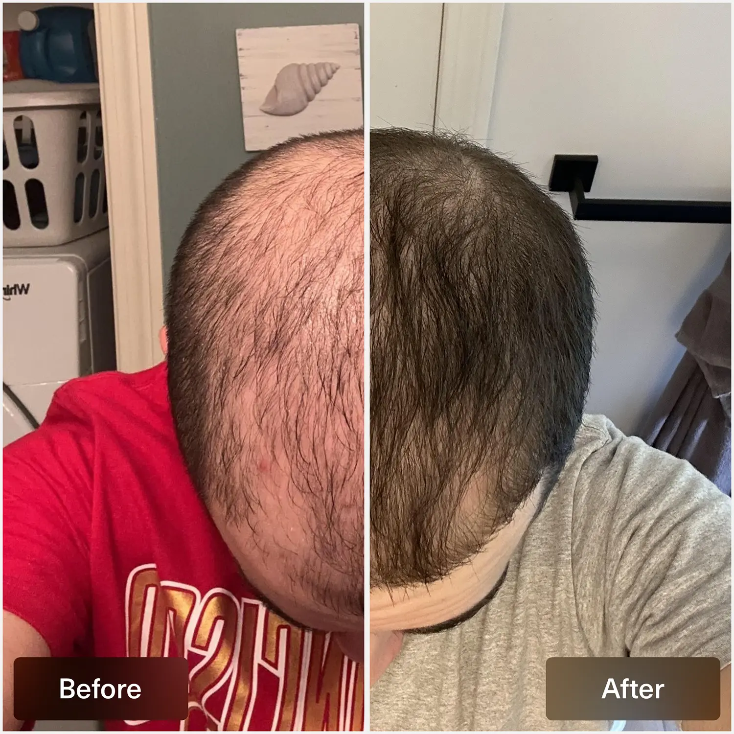 Finasteride où acheter
