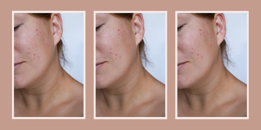 Roaccutane achat internet