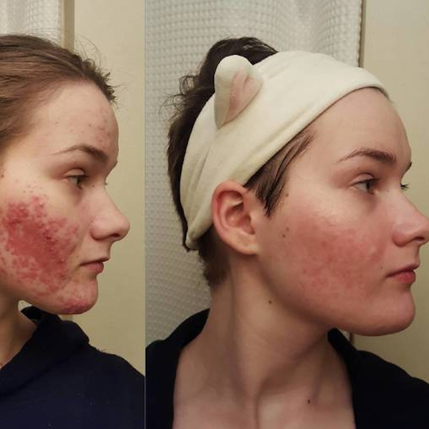 Accutane 30mg Online