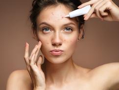 Prix traitement roaccutane