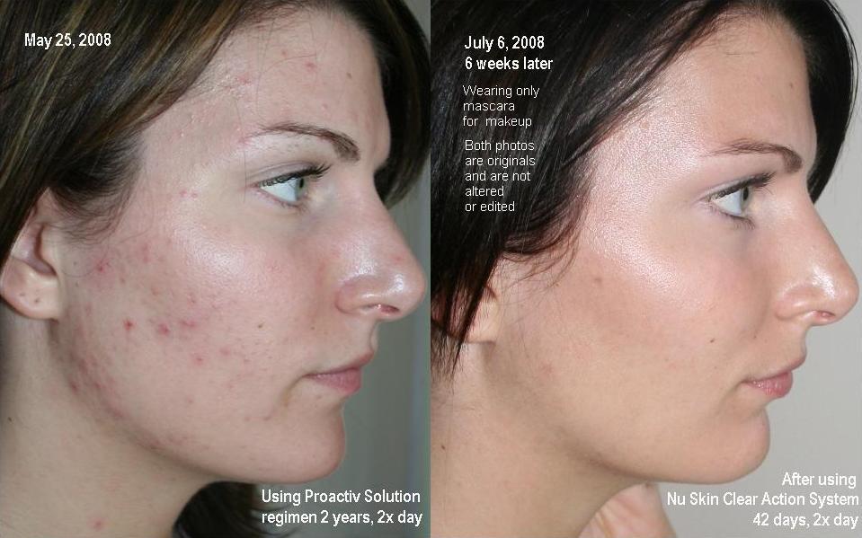 Roaccutane arret pilule