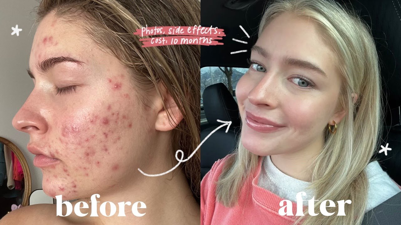 accutane en ligne