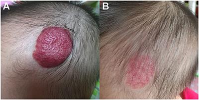 Propranolol en france