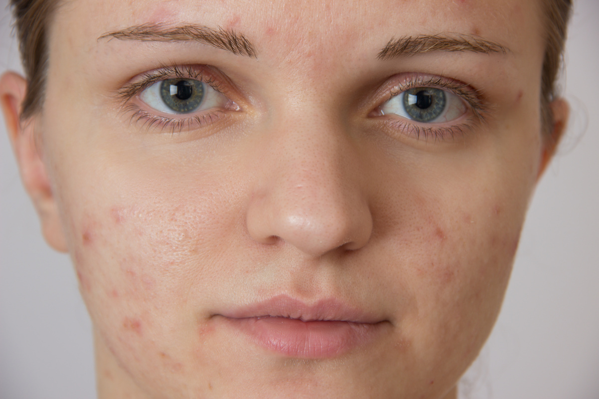 Accutane 30mg
