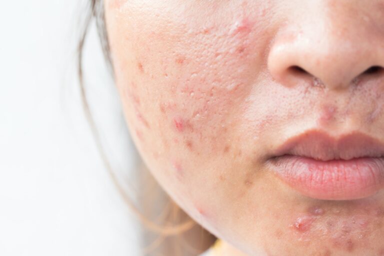 Prix traitement roaccutane