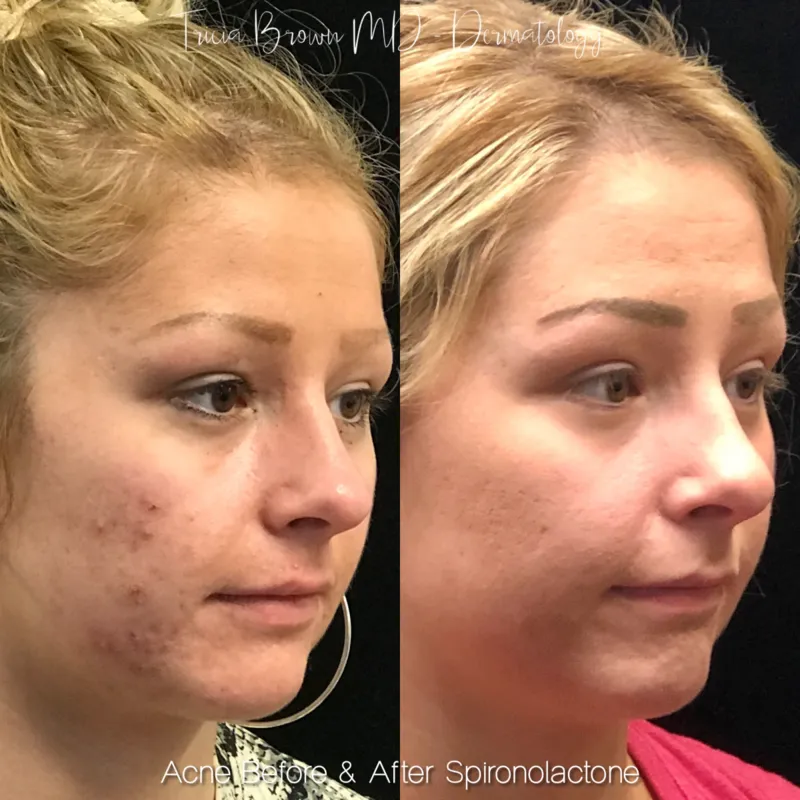 Roaccutane Online