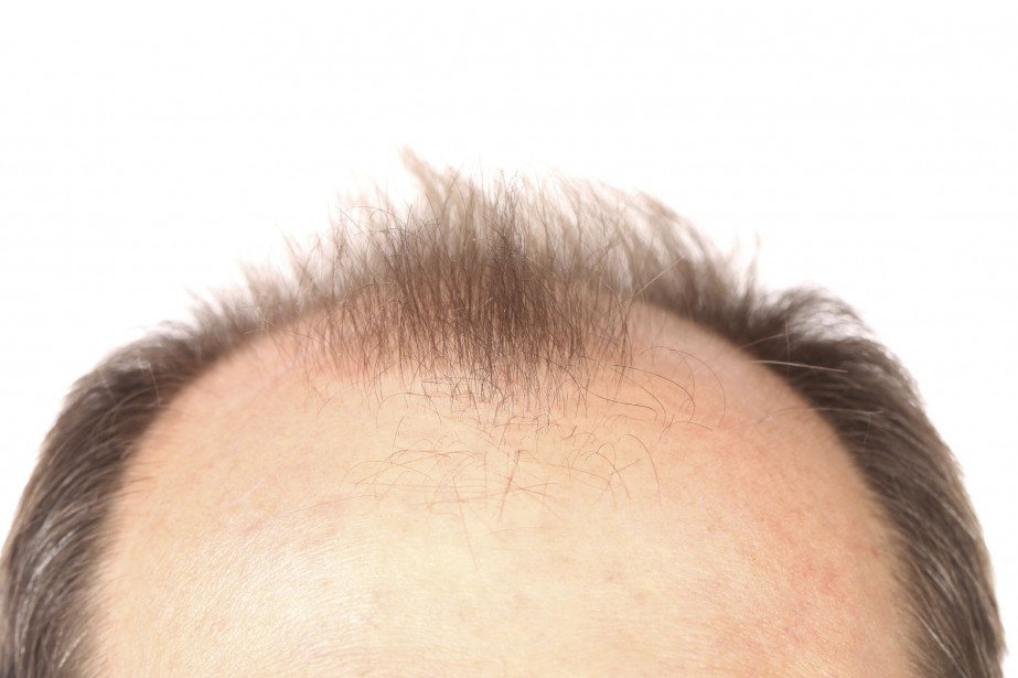 Finasteride bon marché