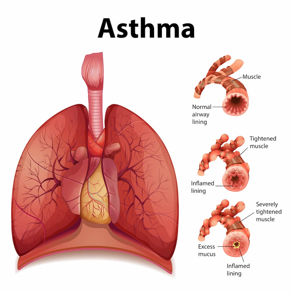 Salbutamol Inhaler France