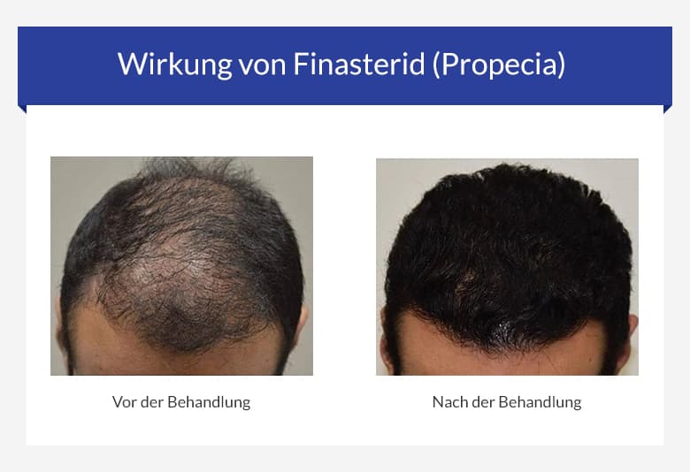 Finasteride pilule