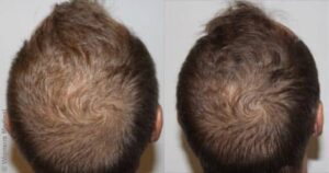 Finasteride Bailleul Achat