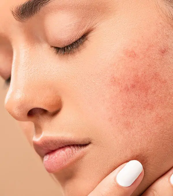 Roaccutane prix 2020