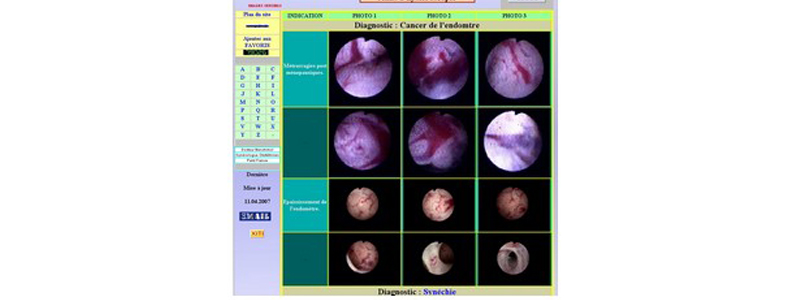 Tamoxifène achat france