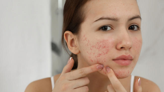 Roaccutane Apres Arret Pilule