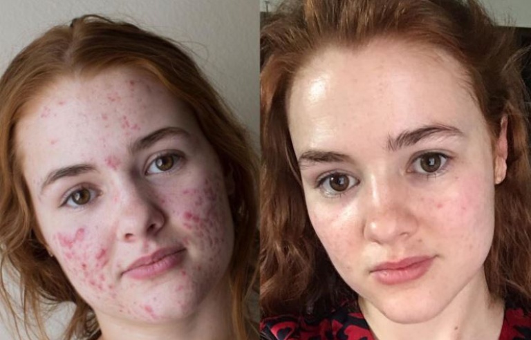 Achat de accutane