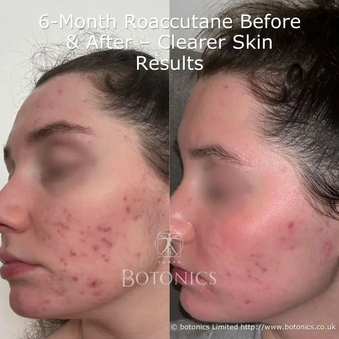 Accutane online europe