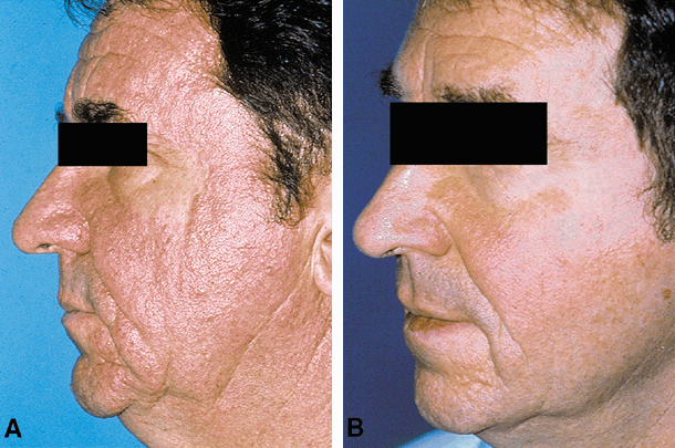 Où acheter du roaccutane
