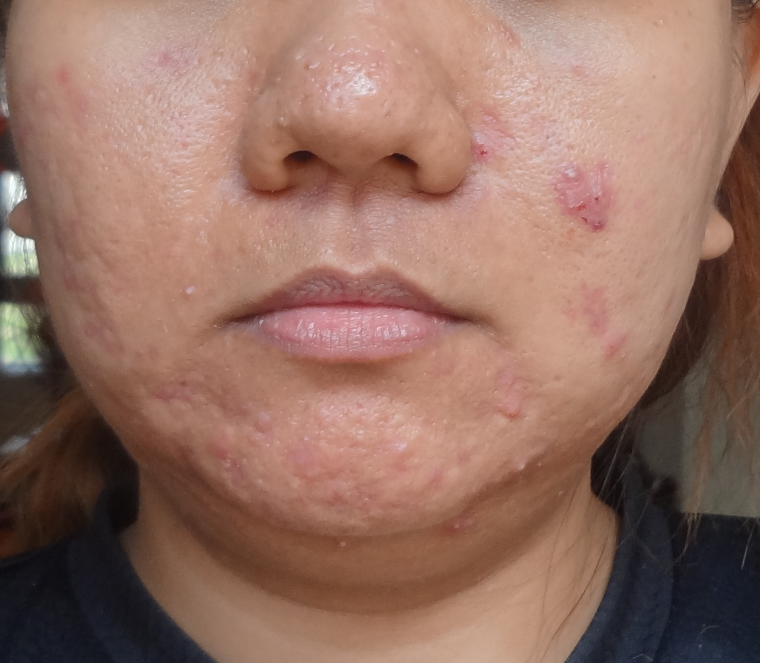 Commander Du Roaccutane En Ligne