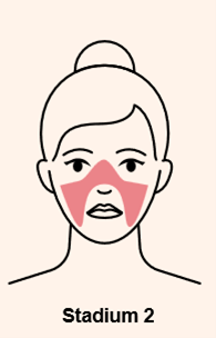 Pilule apres roaccutane