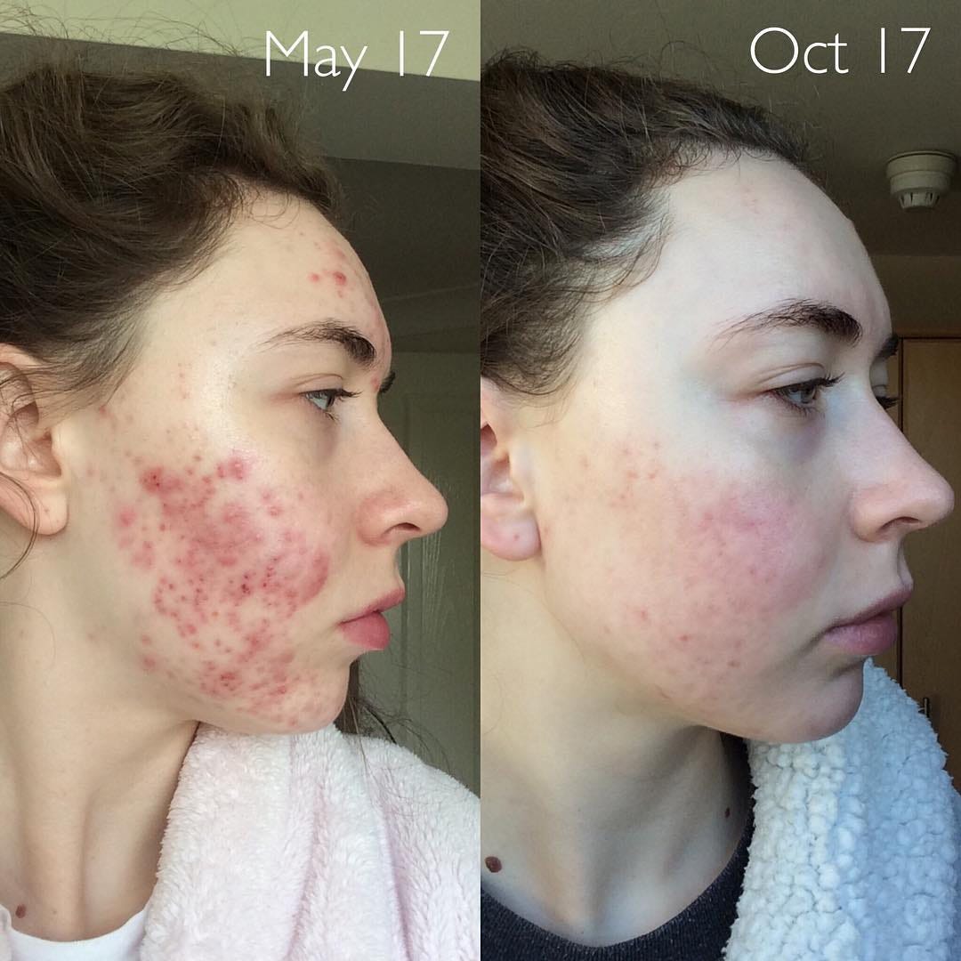 Isotretinoin 5mg