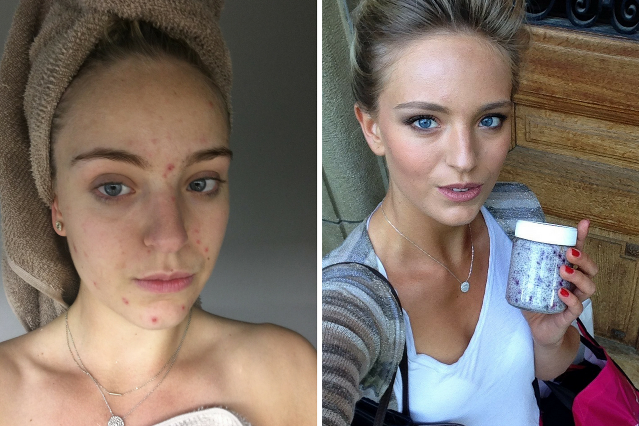 Roaccutane i kontracepcijske pilule
