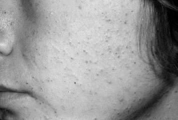 Isotrex pilule