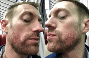 accutane moins cher