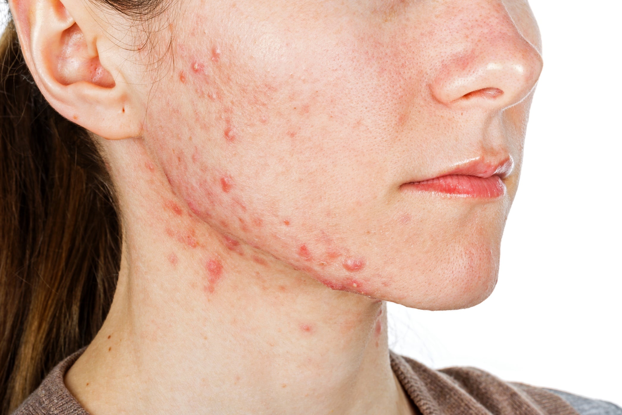 Roaccutane sans ordonnance