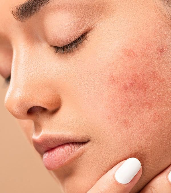 Prix de roaccutane
