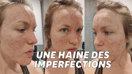 Acheter du isotretinoin générique