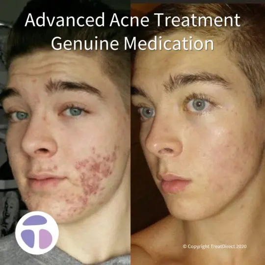 Roaccutane prix 2020