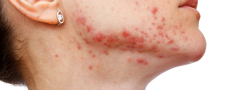 Accutane online eu