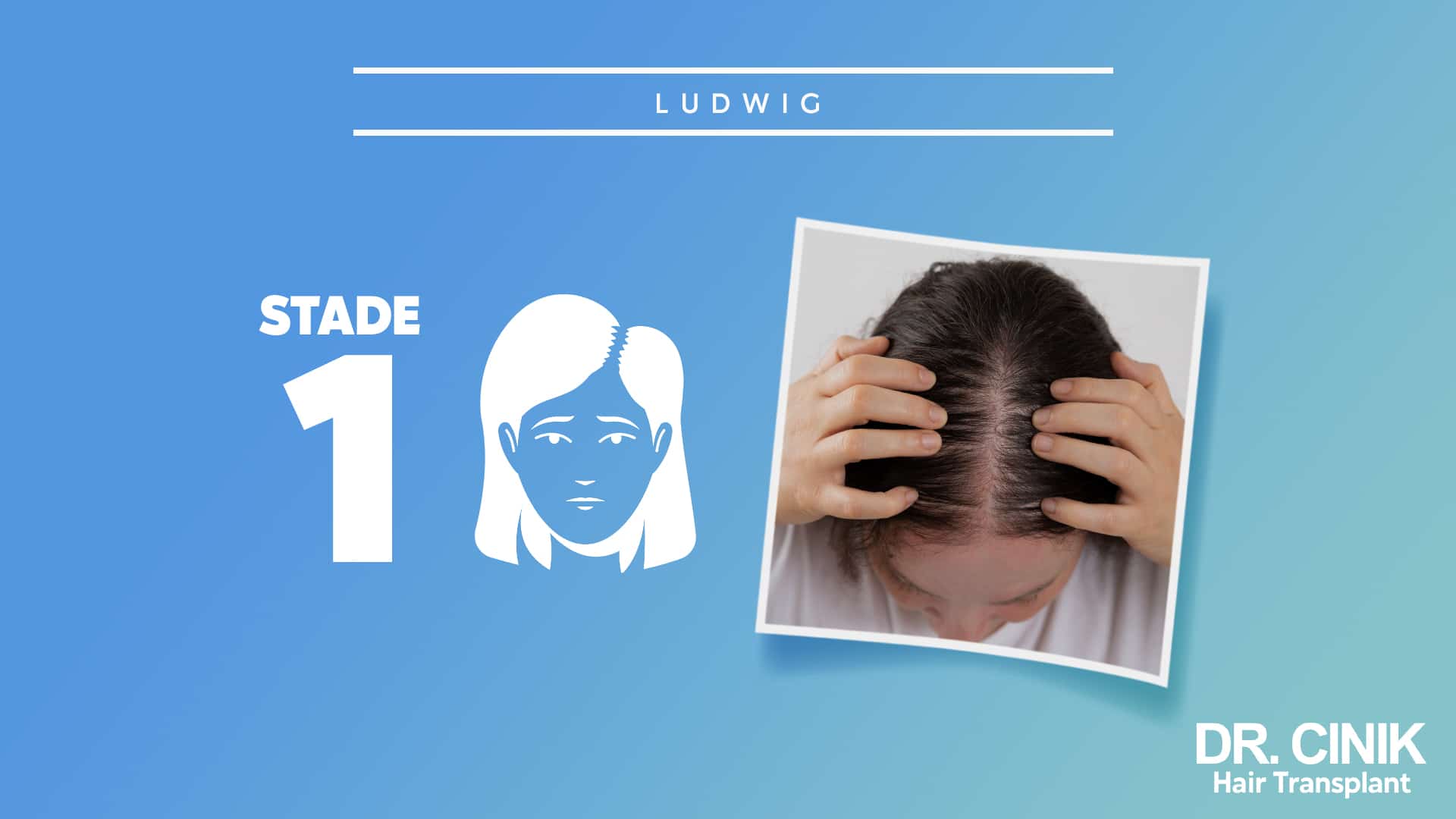 Finastéride 1mg prix