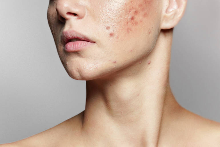Roaccutane acné pilule