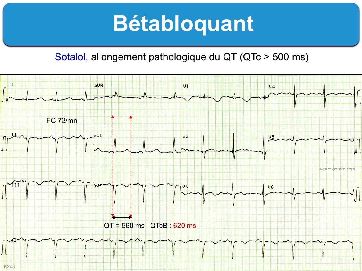 Propranolol 20 Mg Palpitations