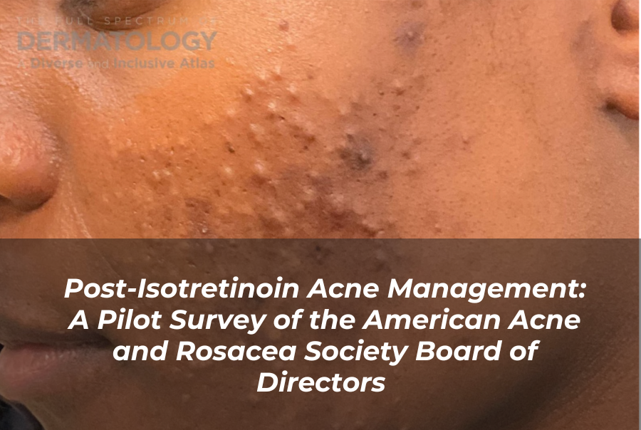 Online Dermatologist Isotretinoin