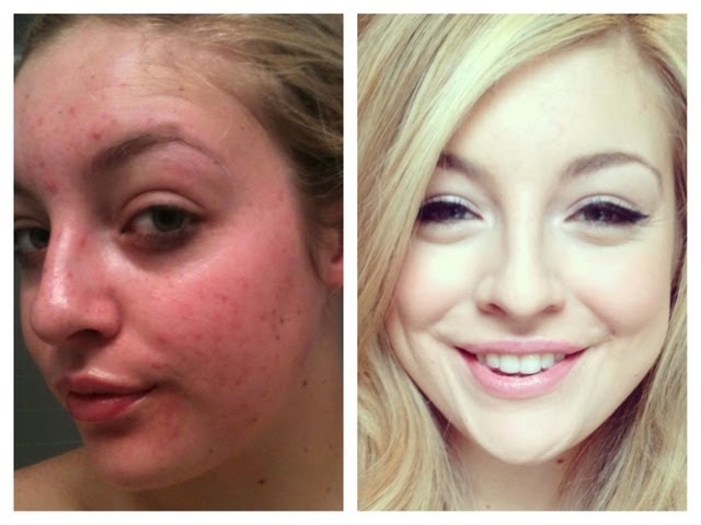 Roaccutane gel france