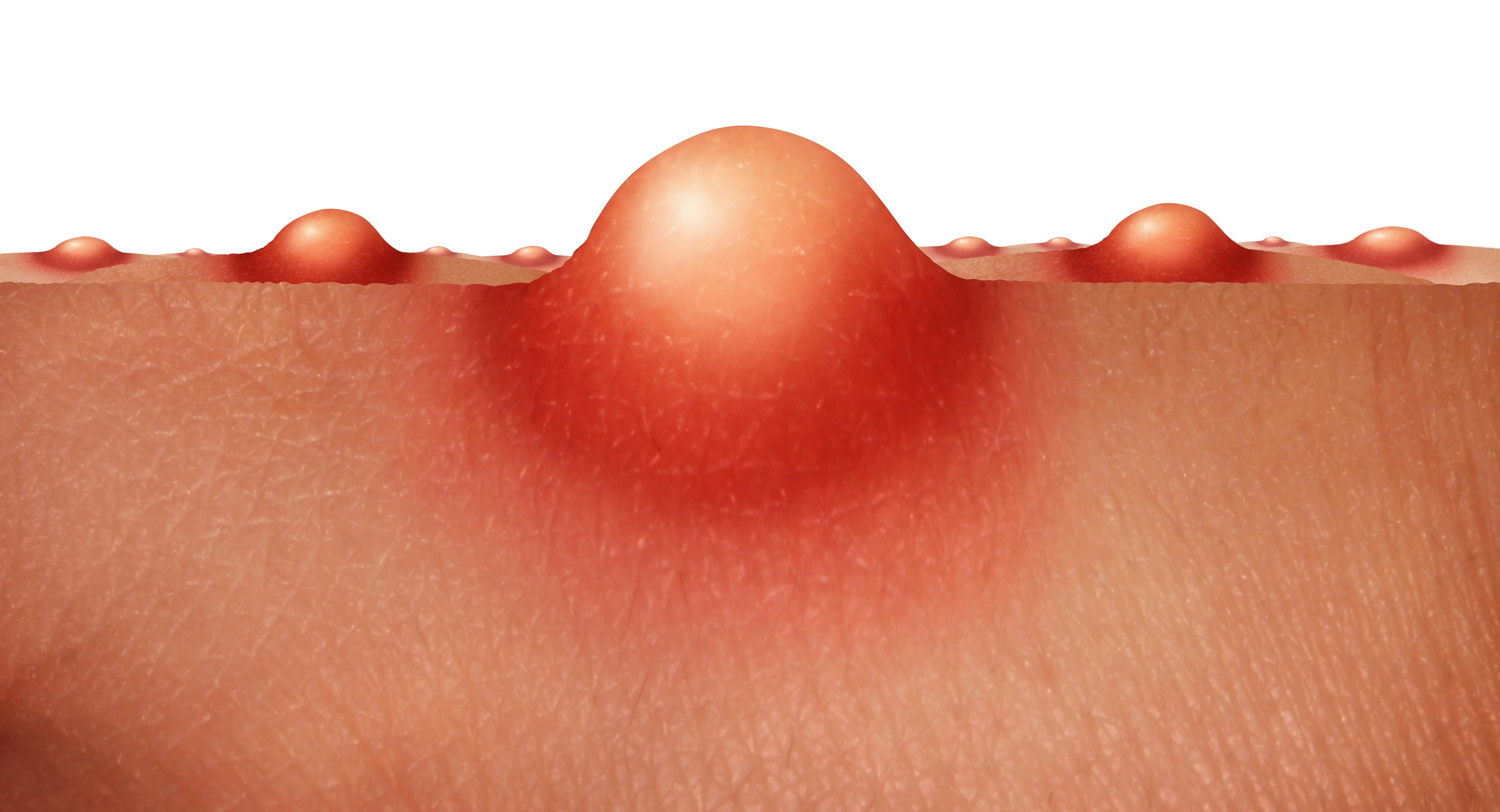 Accutane Achat