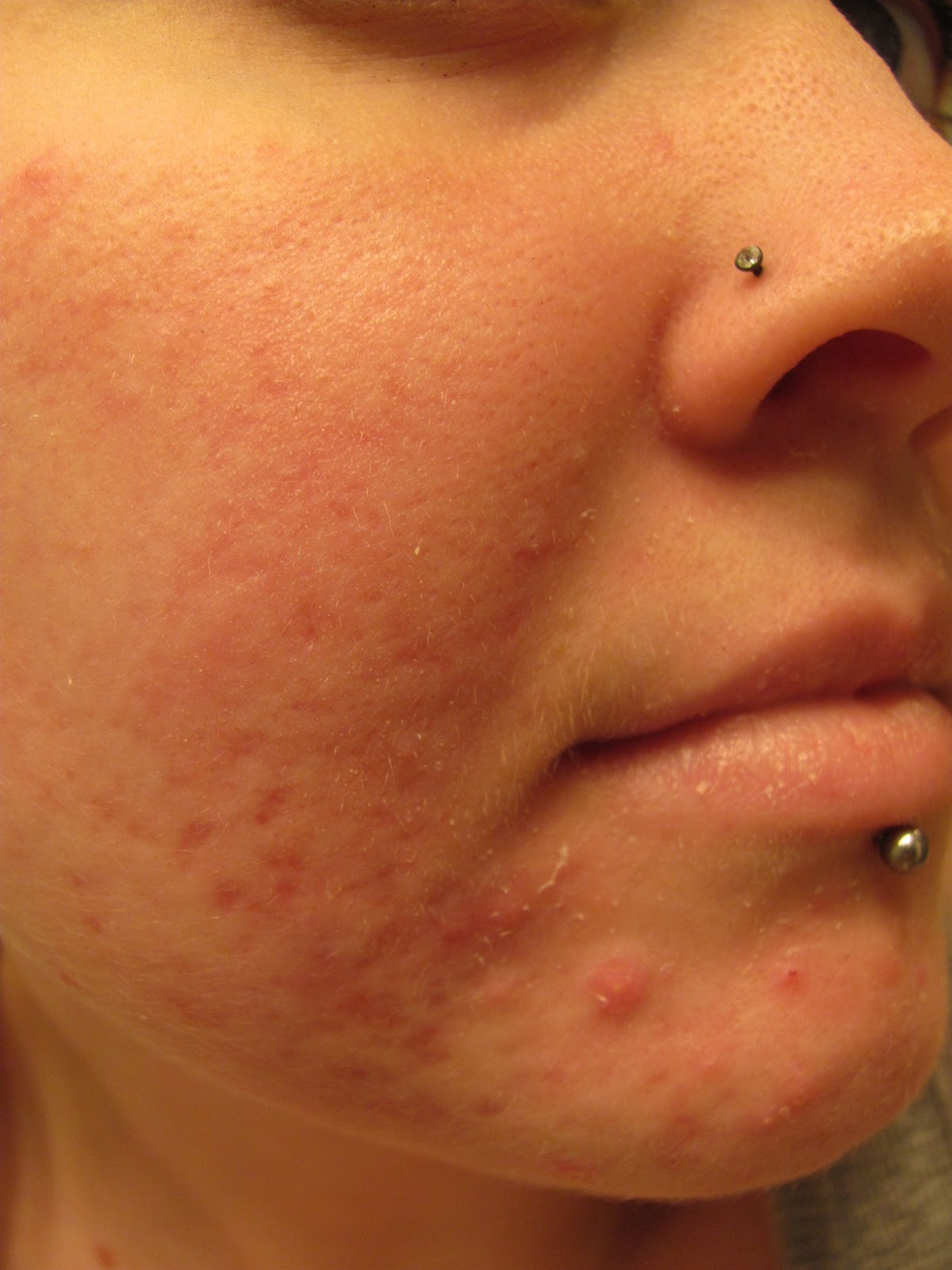 Accutane pilule