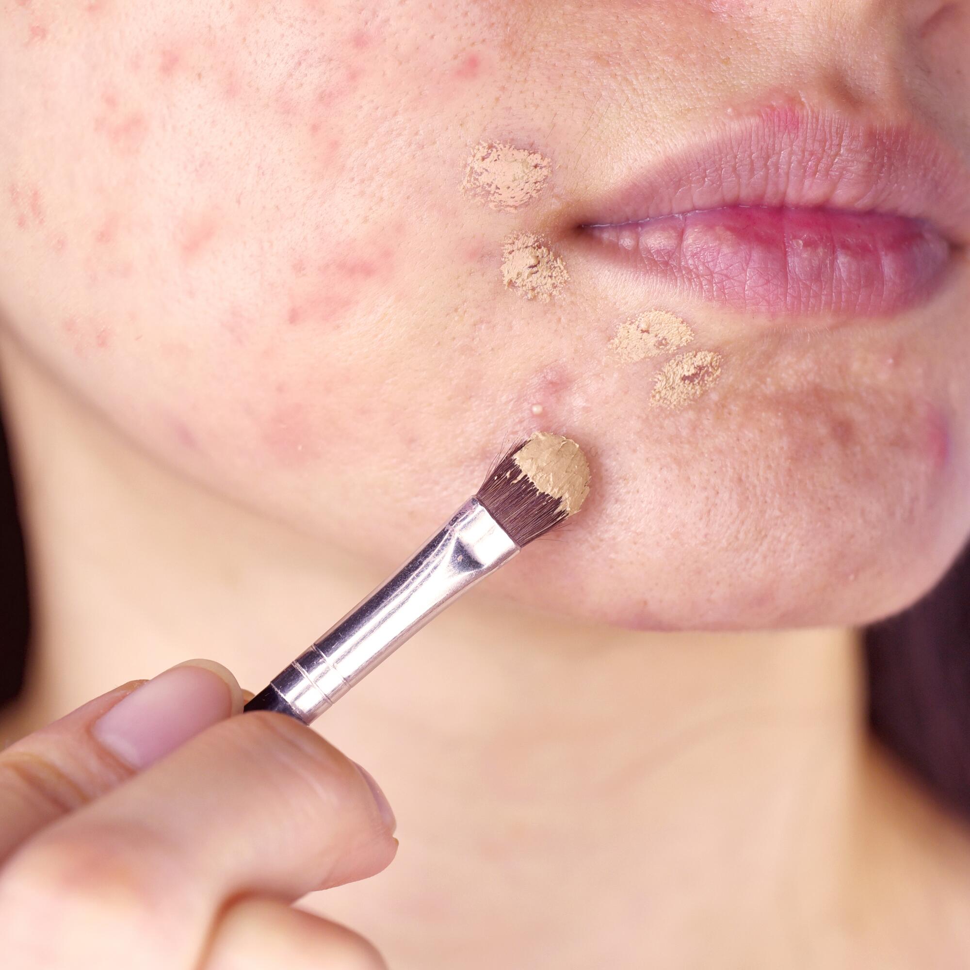 acheter roaccutane gel