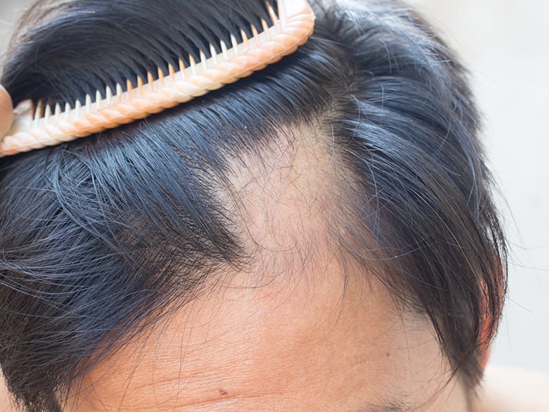 finasteride en france