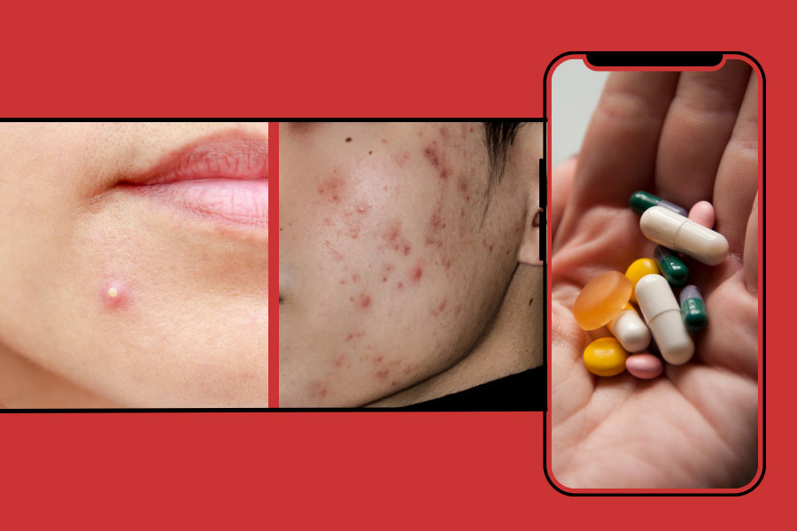 Online Dermatologist Isotretinoin