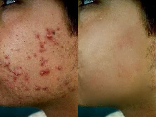 Roaccutane Arret Pilule