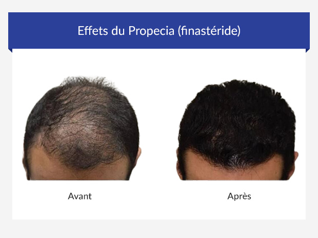 Propecia générique efficacité