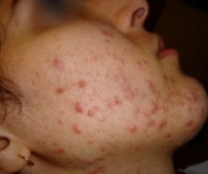 acheter du isotretinoin générique