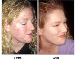 Roaccutane pilule