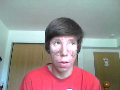 Coût accutane