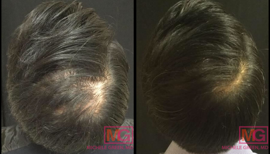 finasteride gel france
