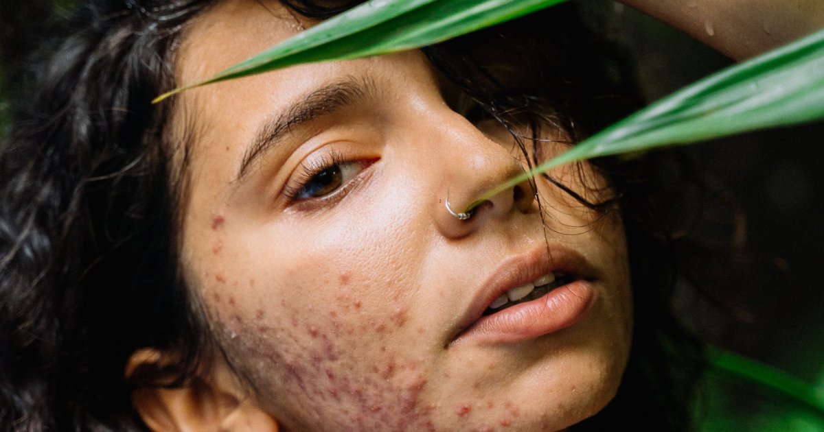 Roaccutane prix acné