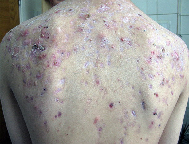 Pilule de roaccutane
