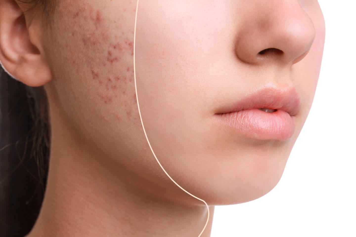 Roaccutane Acheter Online